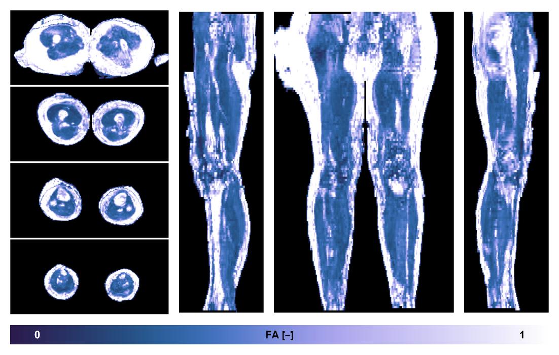 IVIM corrected whole leg muscle fractional anisotropy obtained from diffusion tensor imaging.